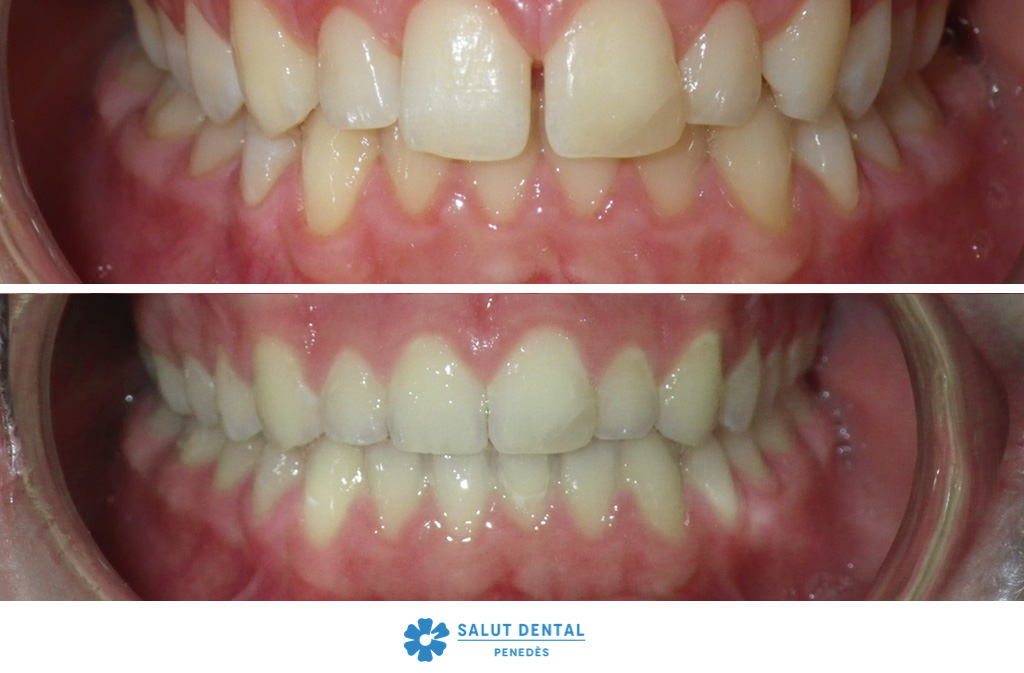 Correcció del diastema (dents separades) amb ortodoncia