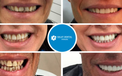 Exemples de carilles dentals: abans i després